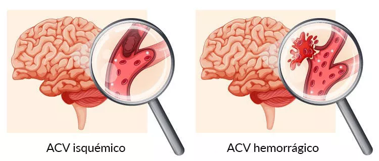 tipos-de-acv