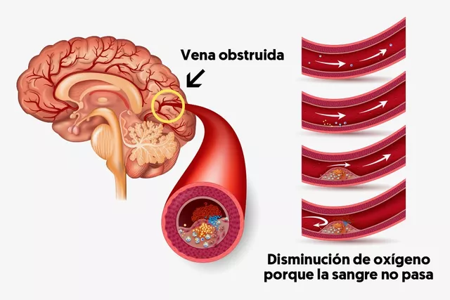 secuelas-de-un-acv_22978_l